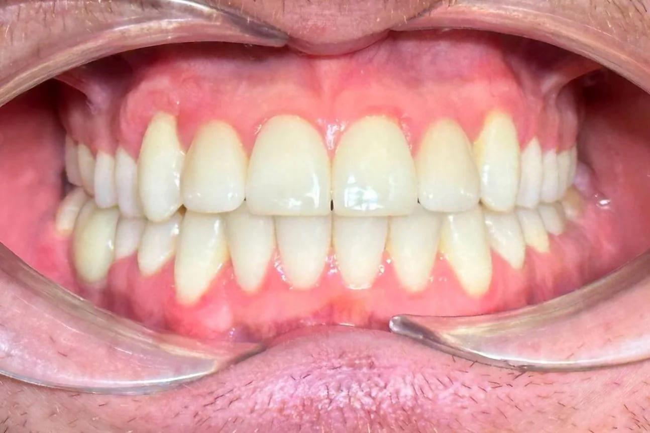 01-braces-after
