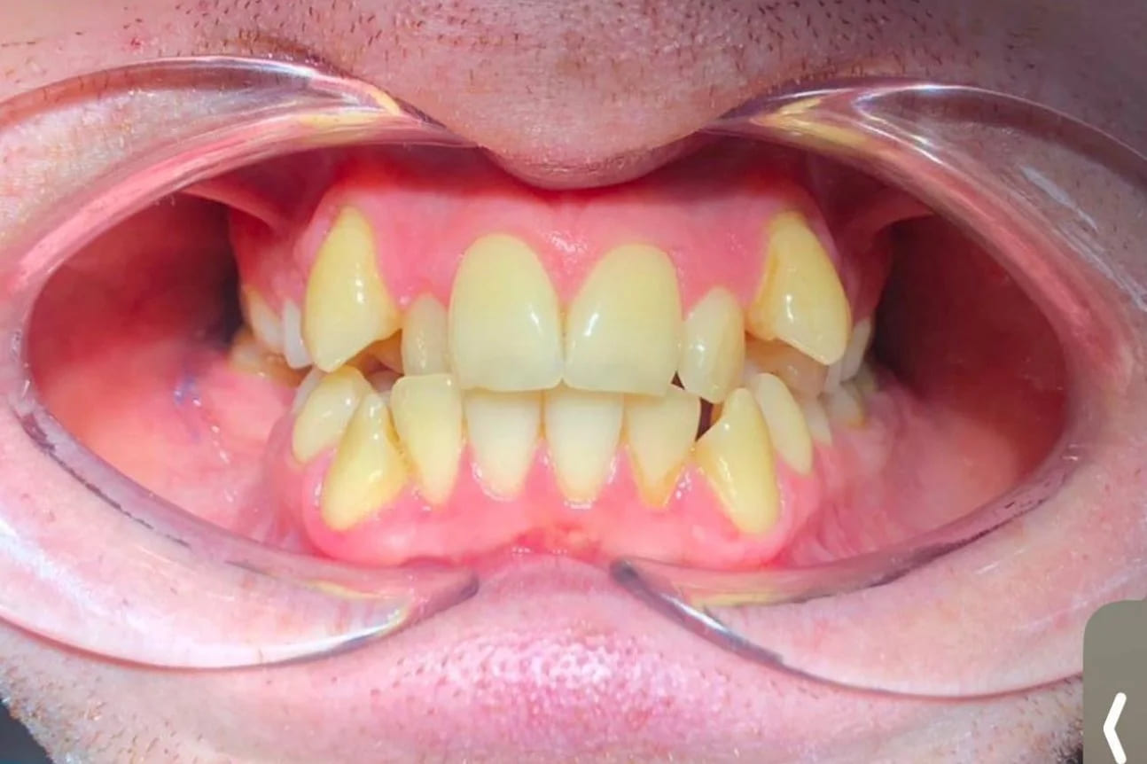 01-braces-before