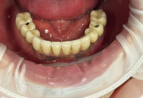 01-implant-after