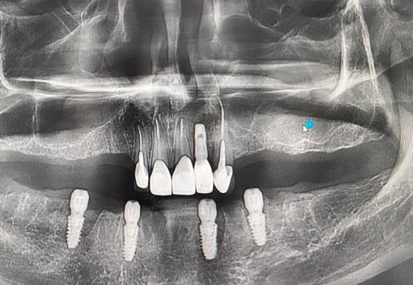 01-implant-before