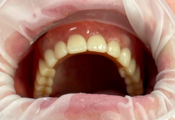 02-implant-after