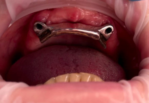 02-implant-before