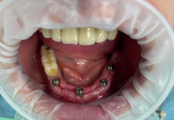 03-implant-before