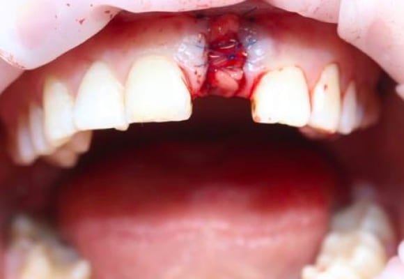 04-implant-before