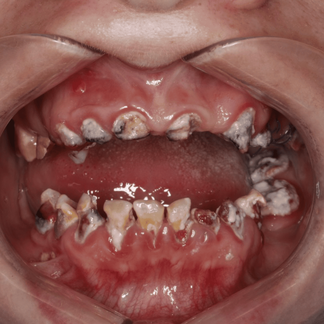 01_implant-keys_before