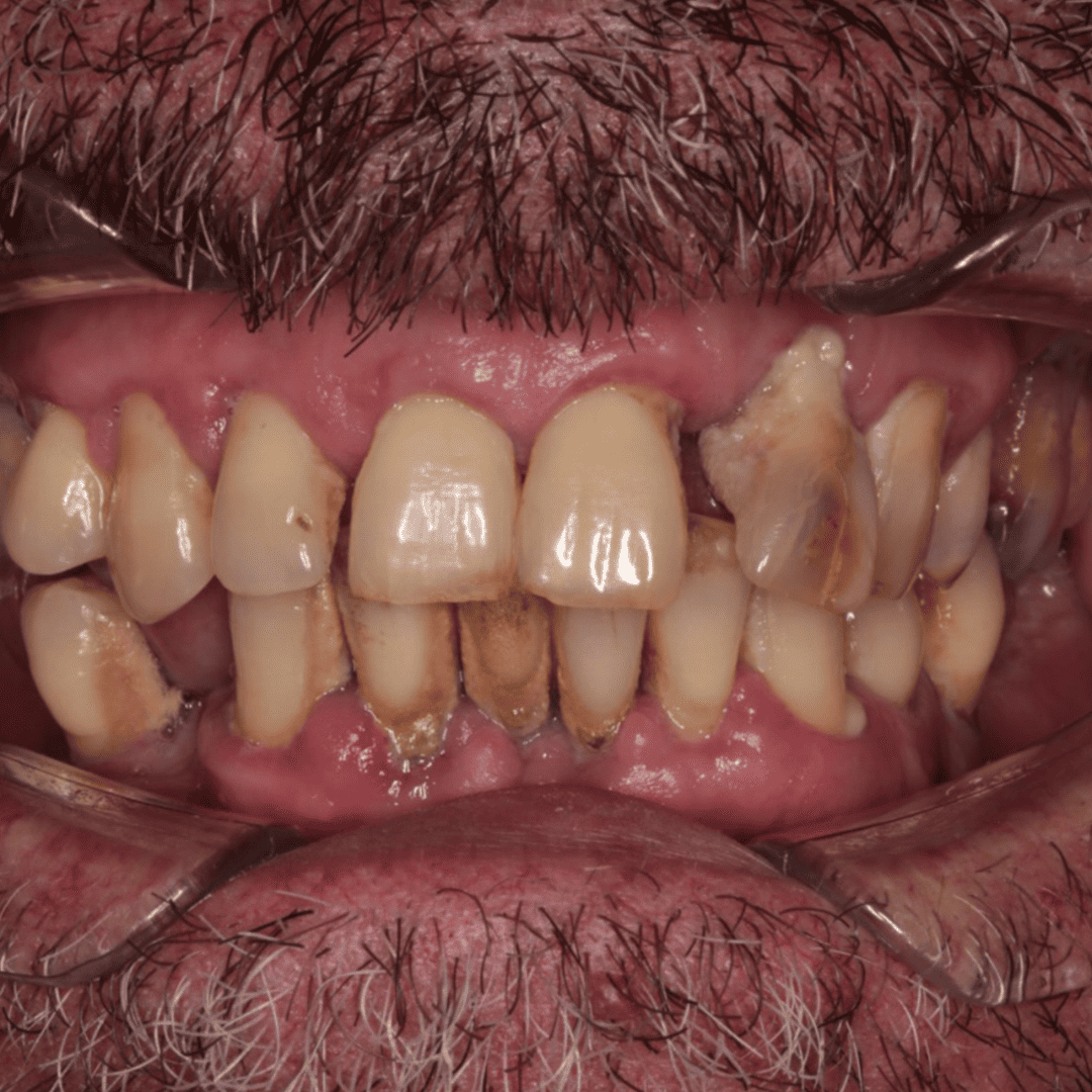 05_implant-keys_before
